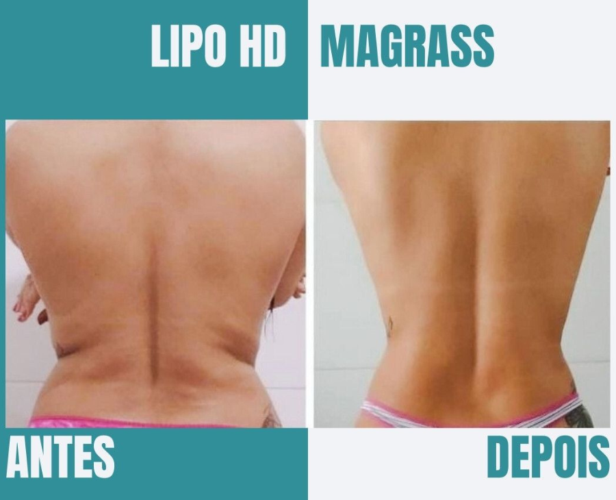 Lipo HD Magrass: Contorno e Beleza Natural